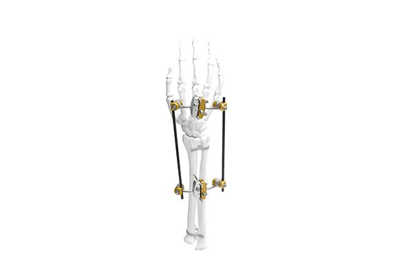 ulna-radius-external-fixator.jpg