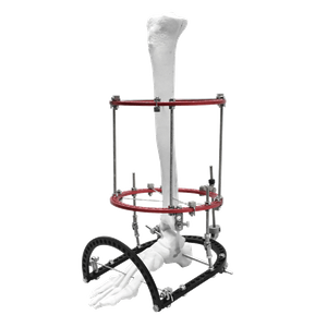 Equinus Ilizarov Fixator