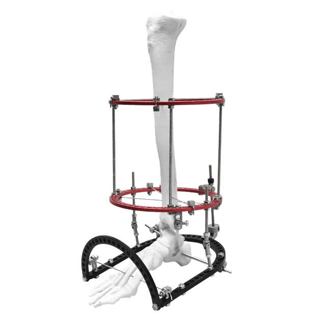 Equinus Ilizarov Fixator