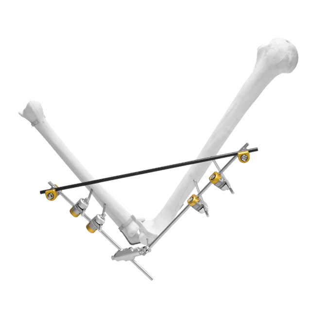 Elbow External Fixator (Integrated)