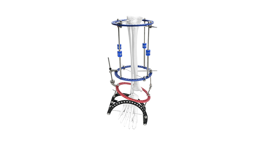 Ankle-valgus-fixators.jpg