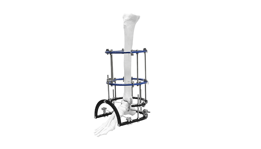 ankle-fusion-fixator