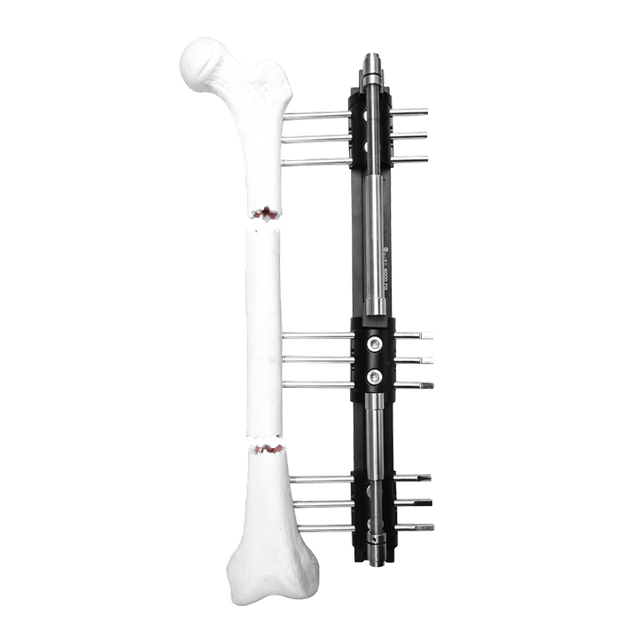 Limb Reconstruction System (L.R.S)