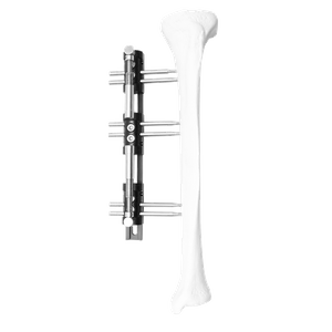 Paediatric Reconstruction External Fixator