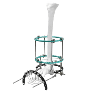 Complex Foot Deformity Ilizarov Fixator