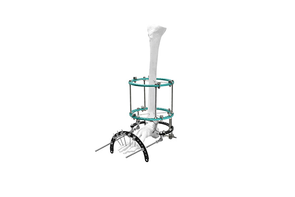 complex-foot-deformity-fixator.jpg