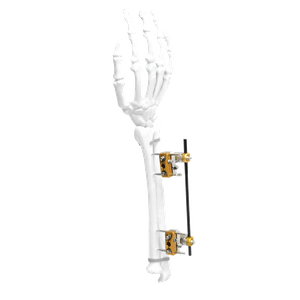 Ulna&Radius External Fixator
