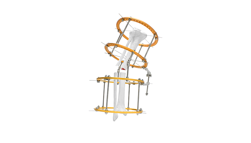 Vara-Tibia-Fixator Vara-Tibia-Fixator