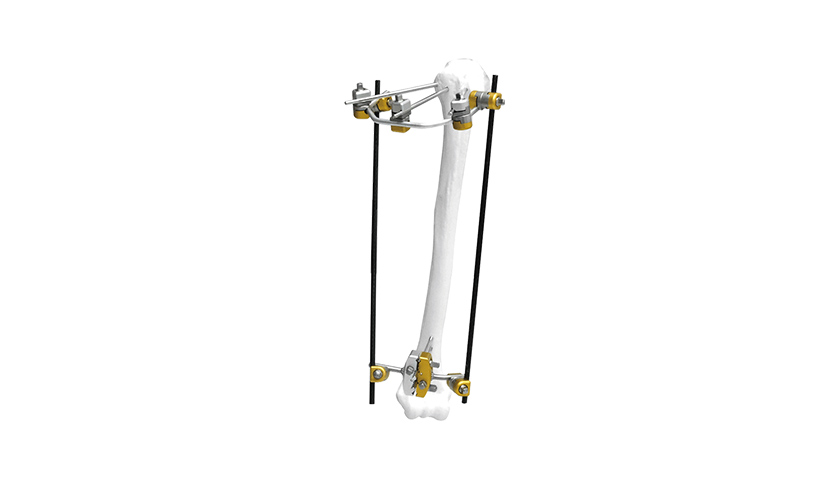 proximal-humerus-external-fixator proximal-humerus-external-fixator