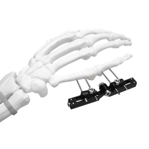 Mini External Fixator (Symmetry axis)