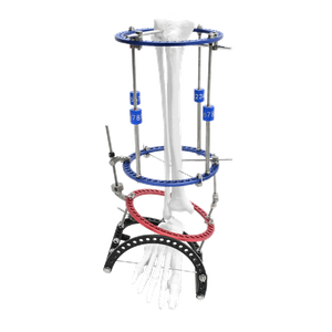 Ankle Valgus Ilizarov Fixator