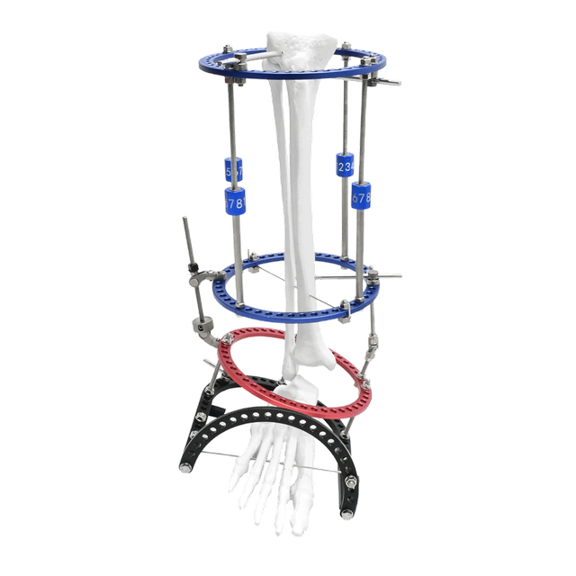 Ankle Valgus Ilizarov Fixator